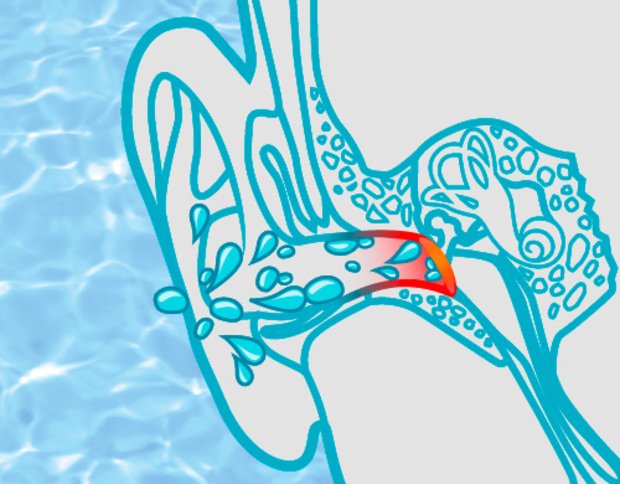 Water in ear: Without SANOHRA swim earplugs the water can penetrate the ear canal when swimming.